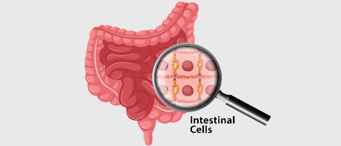 intestine cancer treatment